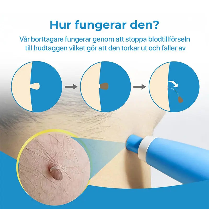 Hudfliksborttagare – Ta bort hudflikar snabbt, enkelt och smärtfritt hemma