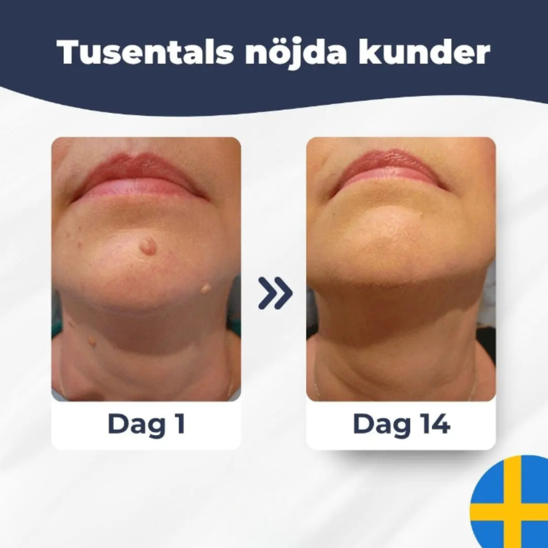 Hudfliksborttagare – Ta bort hudflikar snabbt, enkelt och smärtfritt hemma
