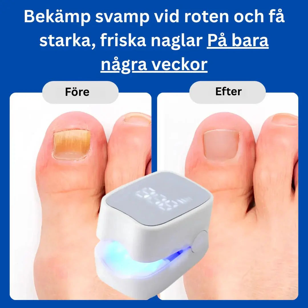 Nagelsvamplaser för Hemmabruk – Smärtfri Behandling mot Nagelsvamp & Missfärgade Naglar