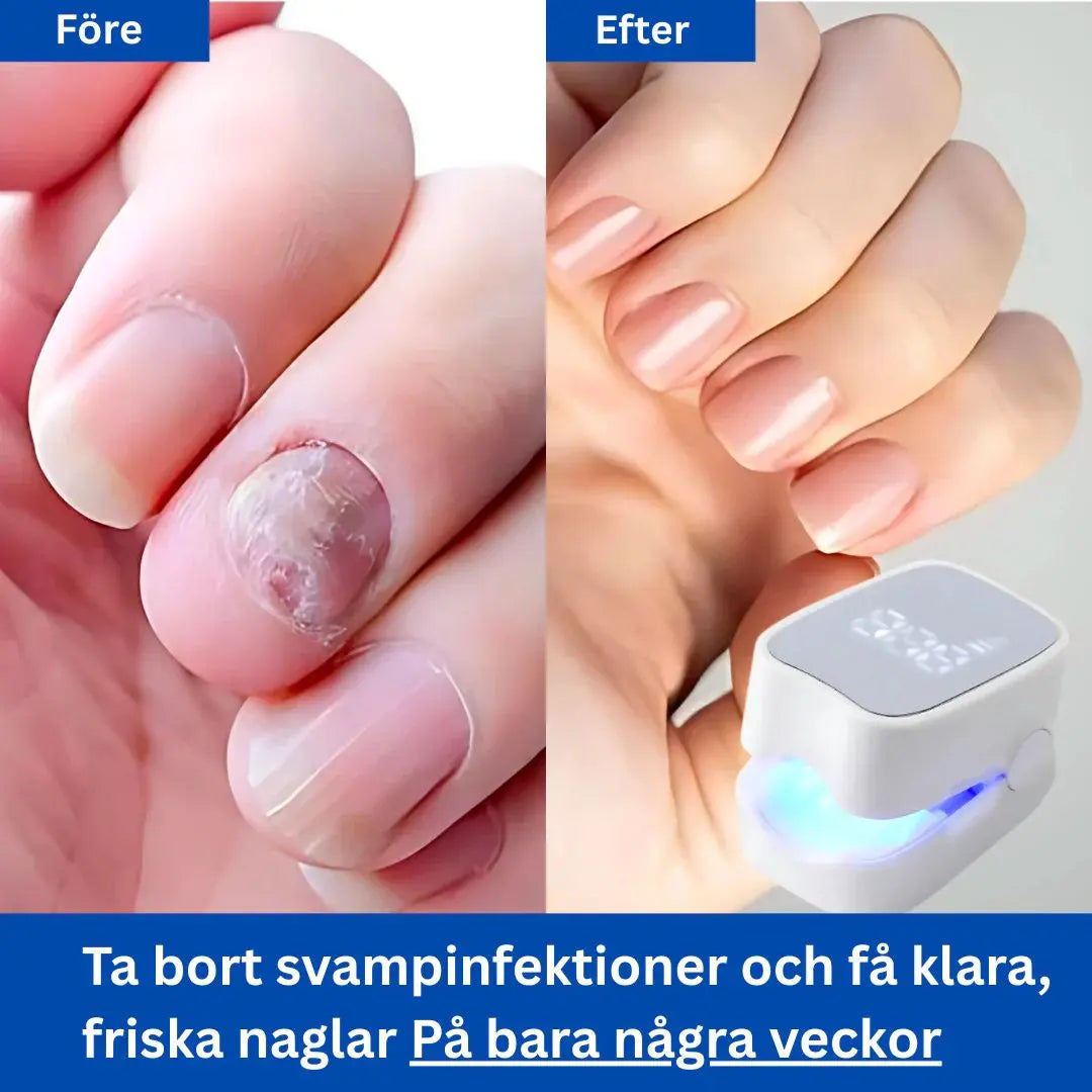 Nagelsvamplaser för Hemmabruk – Smärtfri Behandling mot Nagelsvamp & Missfärgade Naglar
